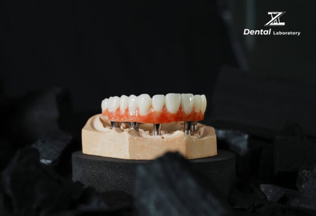 Cấy ghép implant đã trở thành phương pháp thay thế răng được ưa chuộng hàng đầu