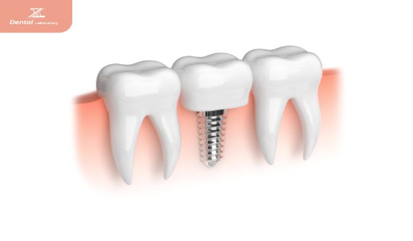 Dental Implant