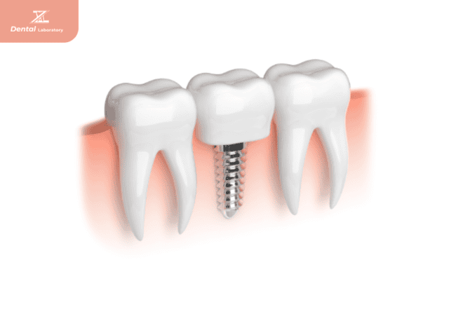 Cấy ghép implants trong nha khoa là gi?