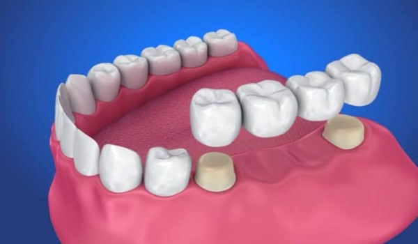 Exploring the Benefits of Crown and Bridge Restorations for Long-Lasting Results