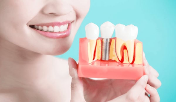 Cost vs. Quality: Finding the Best Value in an Implant Teeth Supplier Company