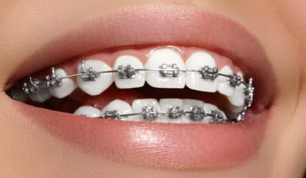 Orthodontic