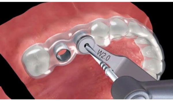 Implant surgical guide